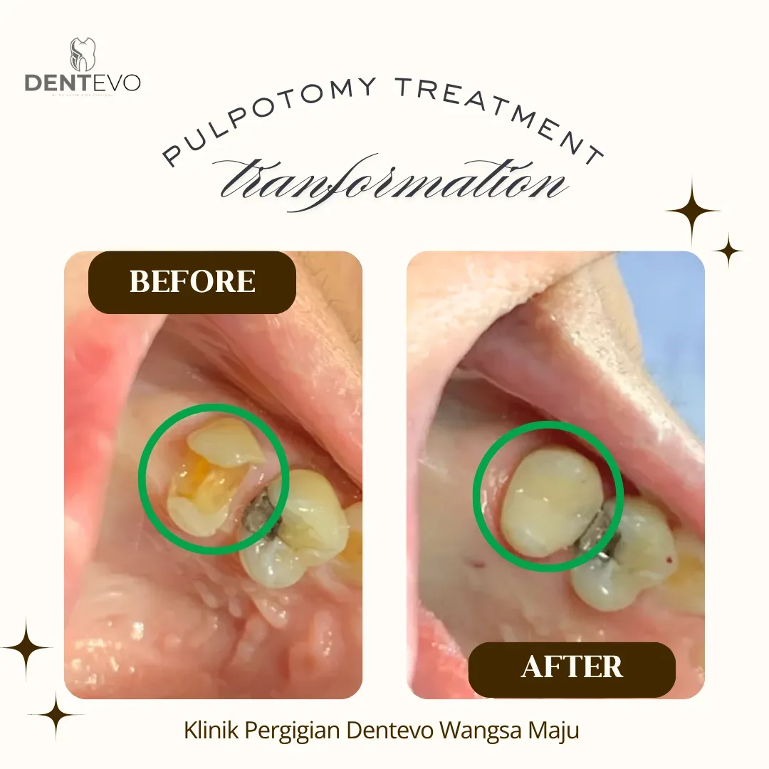 Sebelum dan selepas rawatan pulpotomy gigi di Klinik Dentevo Wangsa Maju
