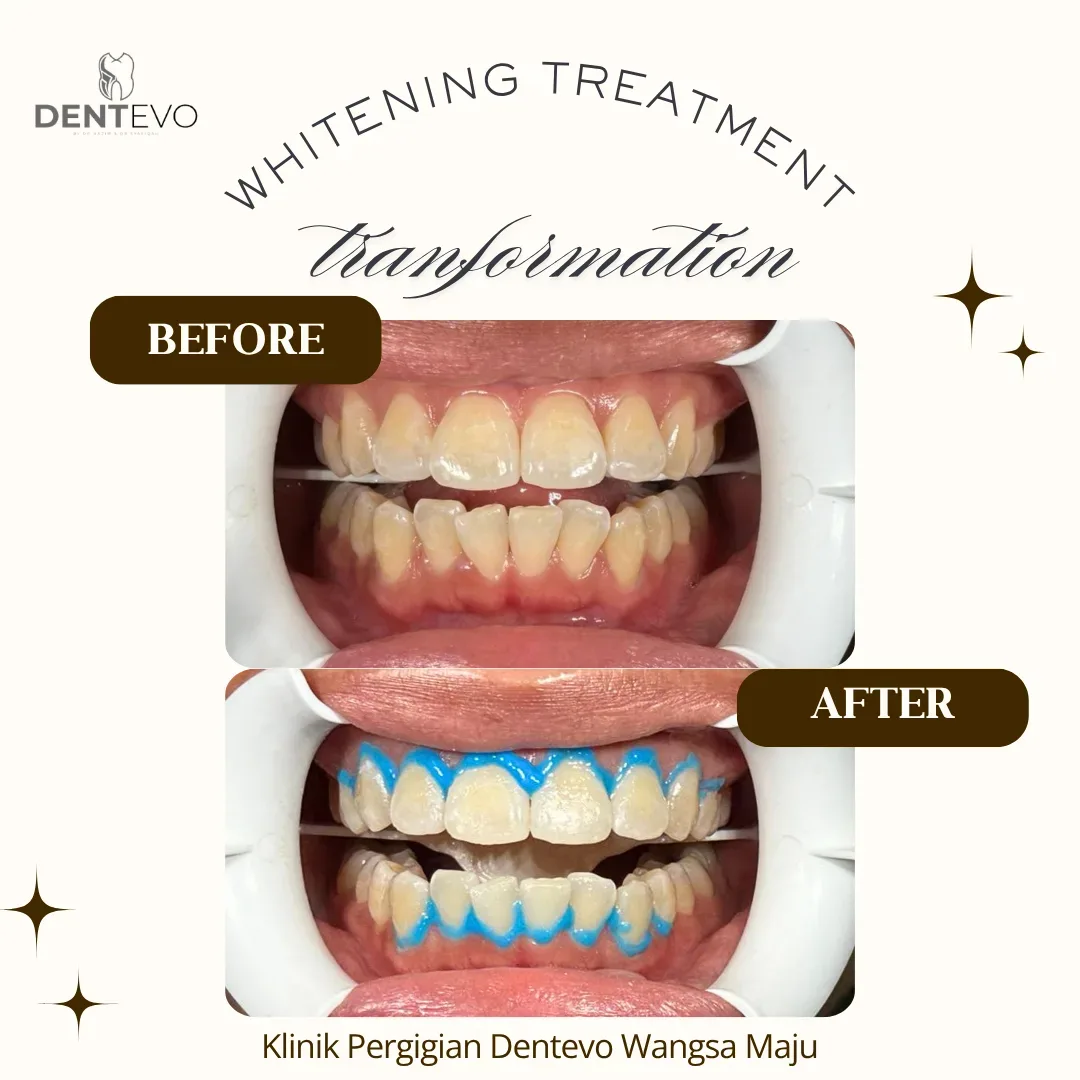 Sebelum dan selepas rawatan whitening gigi di Klinik Dentevo Wangsa Maju