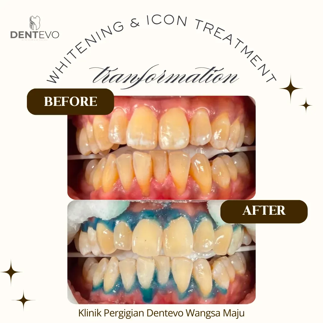 Sebelum dan selepas rawatan whitening dan Icon di Klinik Dentevo Wangsa Maju